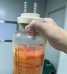 泉州水动力吸脂手术要做多久？